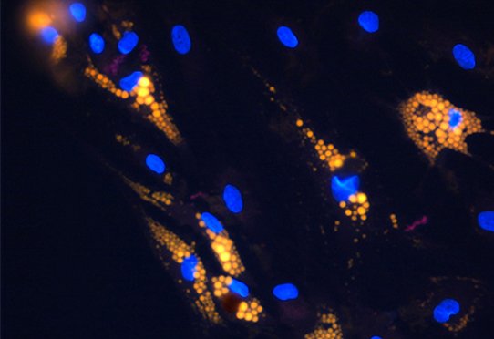 Cultured adipocytes obtained from mesenchymal stem cells (lipid droplets in yellow, cores in blue).